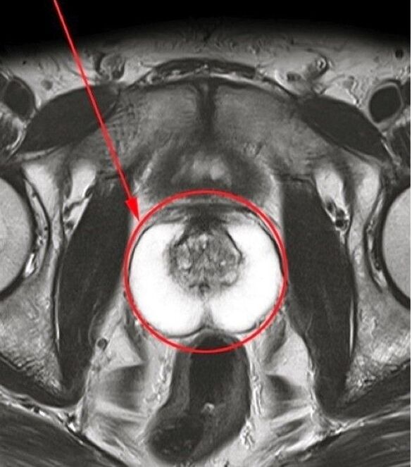 Immagine di capsule di predtonorm dopo aver usato le capsule