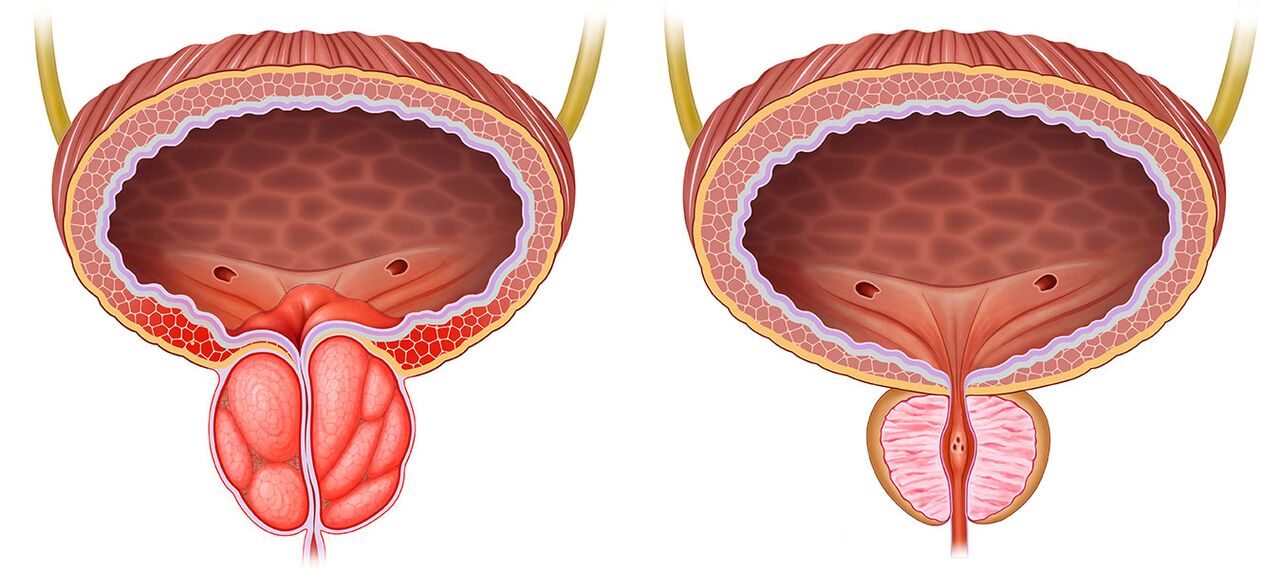 Prostata infiammata e sana dopo aver usato le capsule di Predstonorm