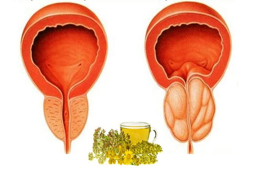 Prostata sana e dolorante