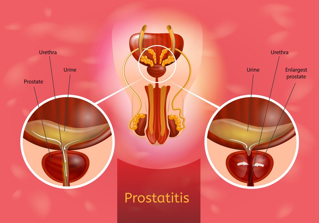 Prostatit
